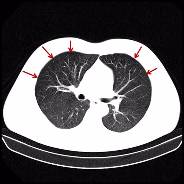 用ct来看看吸烟所导致的肺众生相