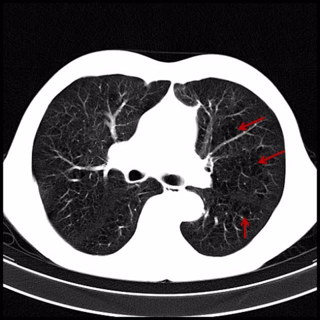 用ct来看看吸烟所导致的肺众生相